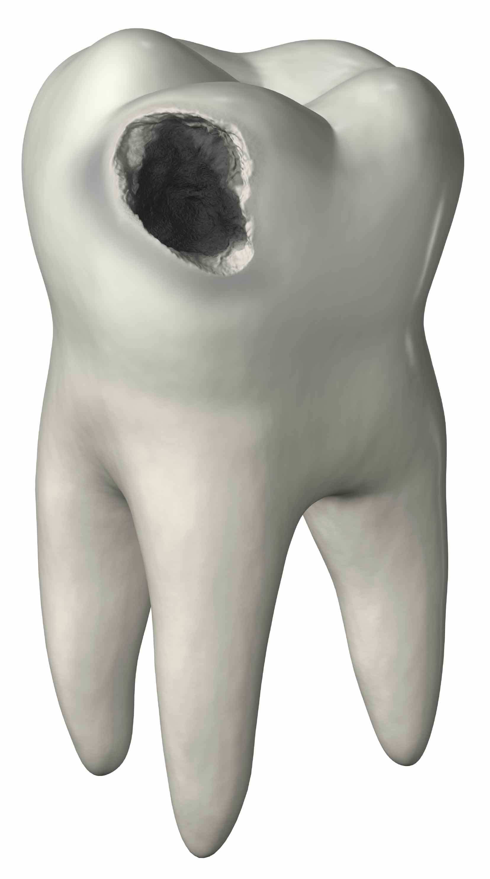 tooth with caries