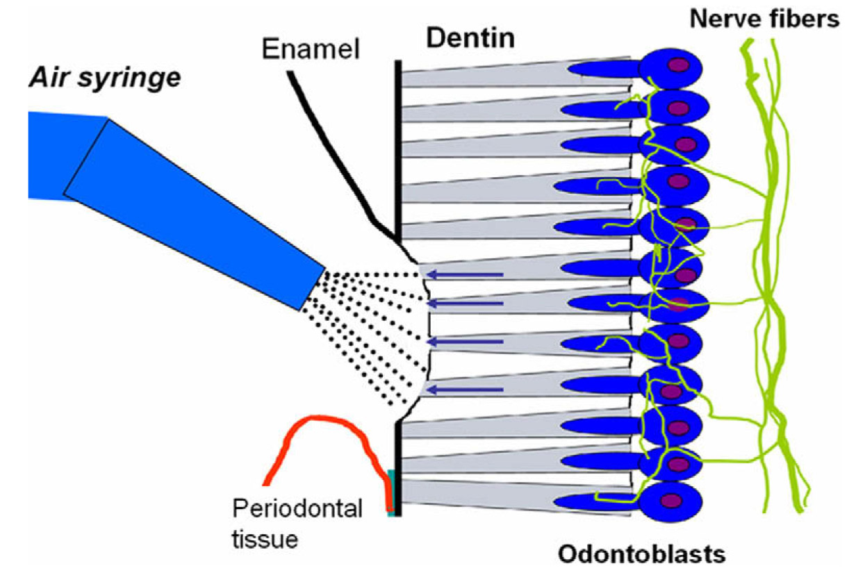 dentin hypersensitivity