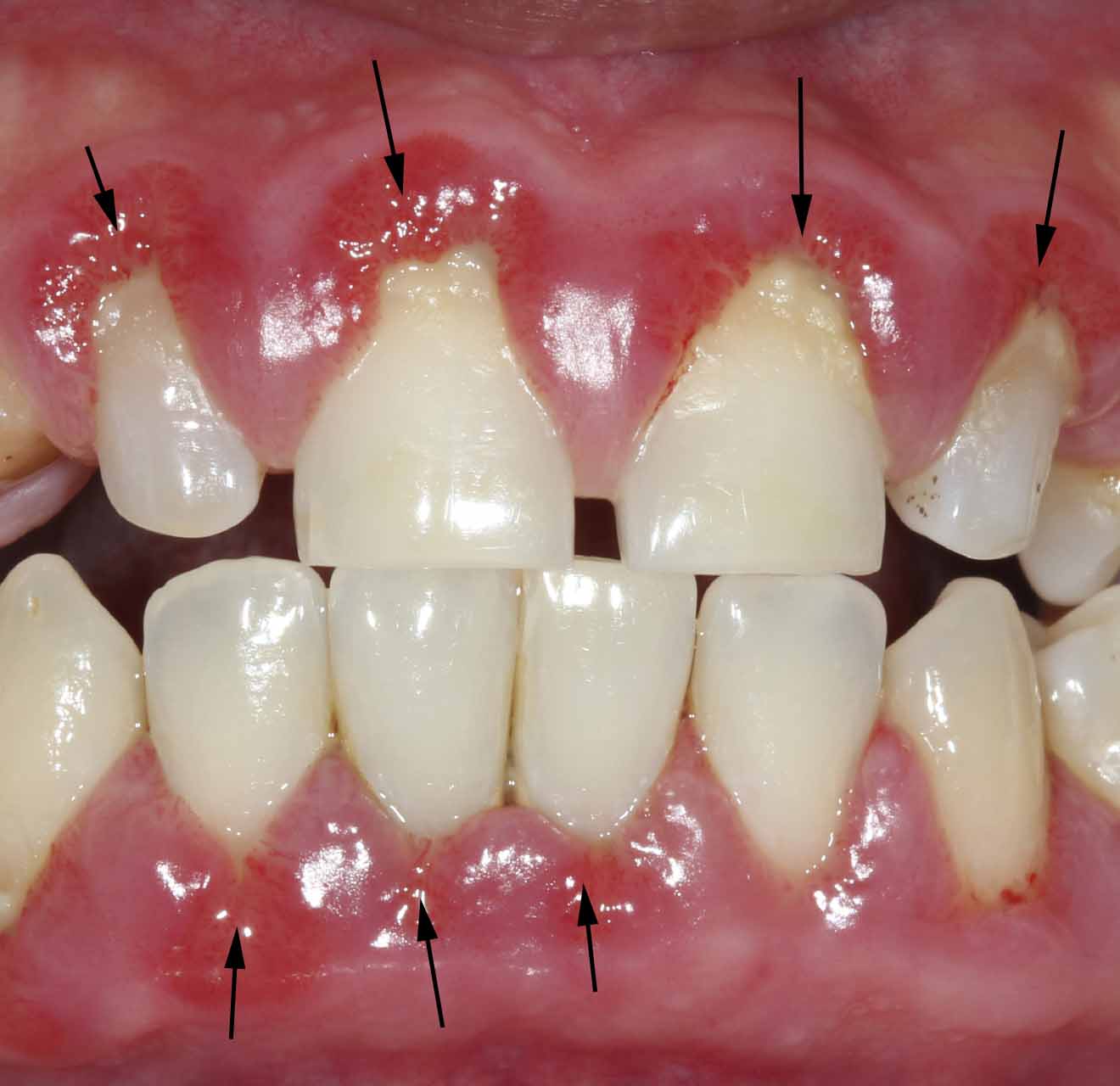 gums with gingivitis