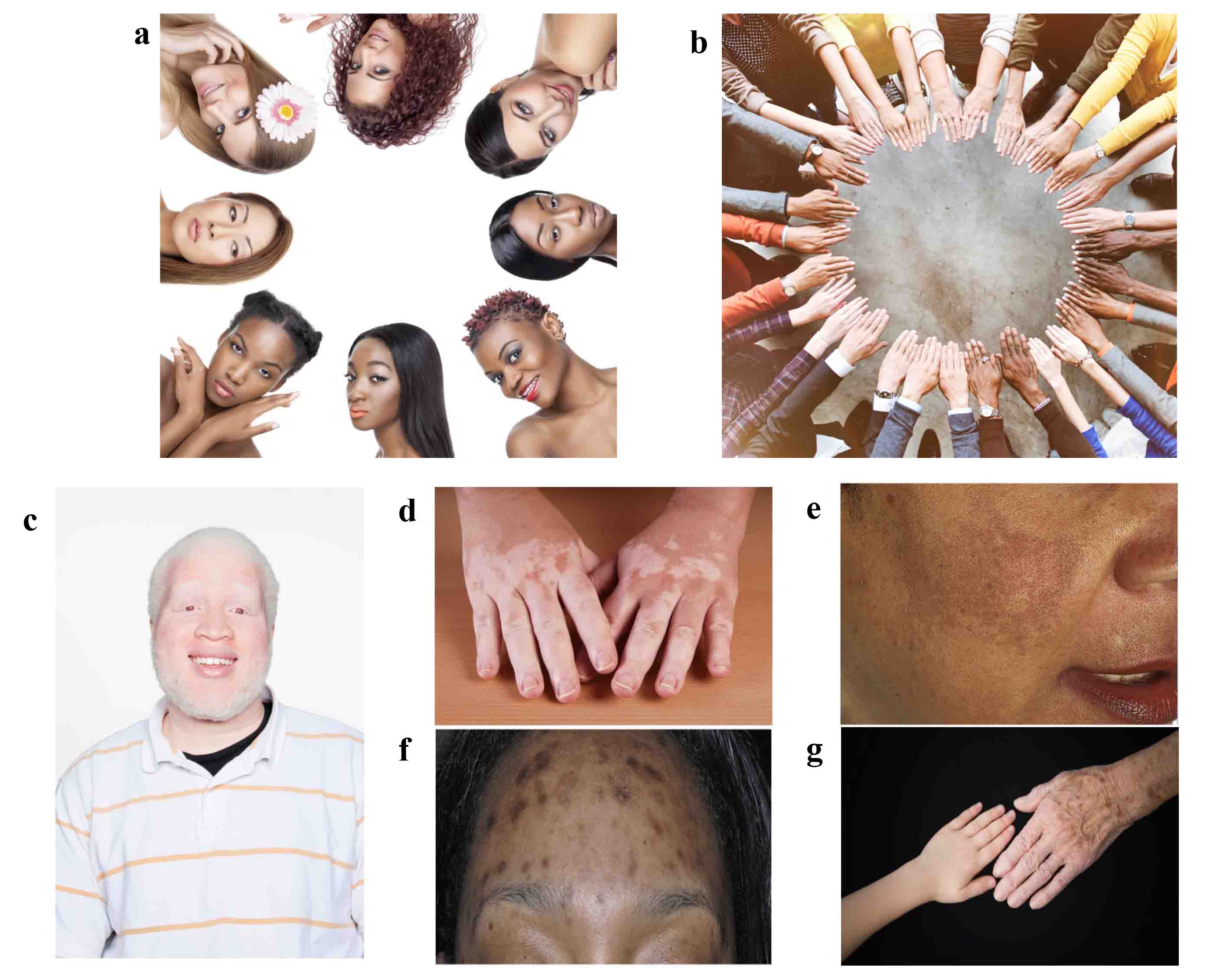 photograph of various skin types (different colors) and also highlighting albinism and skin diseases affecting melanin production 