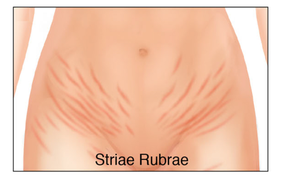 illustration of stretch marks--striae rubrae