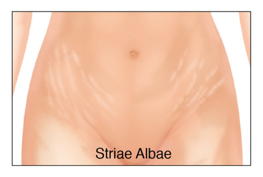 illustration of stretch marks--striae albae
